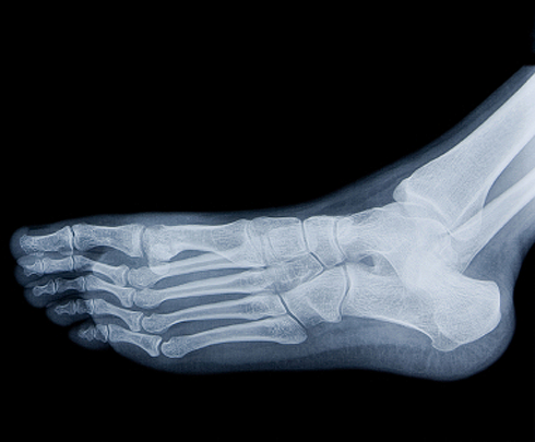 Foot Injuries